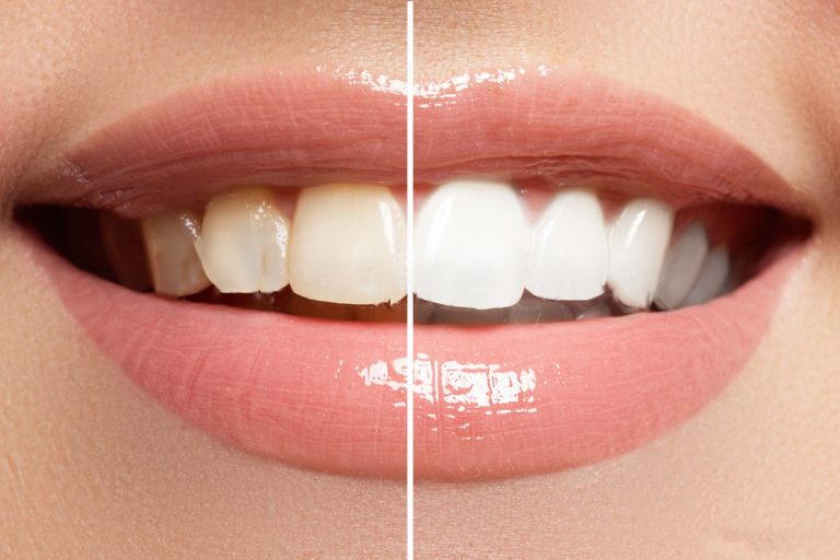 googong-dental-teeth-whitening